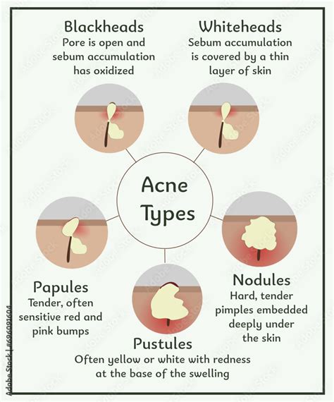 Acne Types Medical Illustration Infographic About Skin And