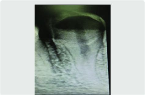 Preoperative Radiograph Of Mandibular Canine Revealed Two Separated