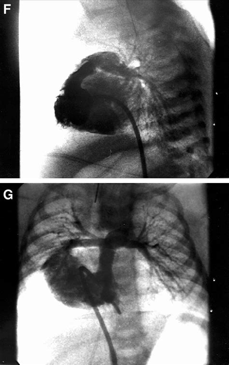 Case 2 F And G Right Ventriculography In Posteroanterior And Left Download Scientific Diagram