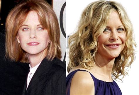 Meg Ryan before and after plastic surgery (3) – Celebrity plastic ...