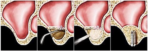 Bone Grafts And Sinus Lift Procedures Oceansight Dental And Implants