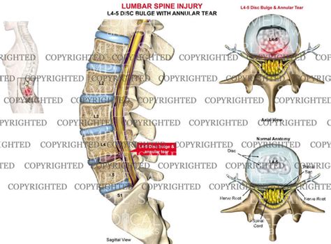 L4-5 Disc bulge — Medical Art Works