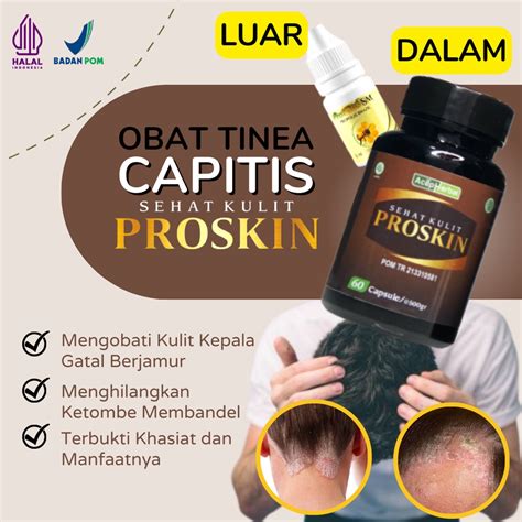 Jual Obat Tinea Kapitis Infeksi Jamur Kulit Kepala Anak Dan Dewasa