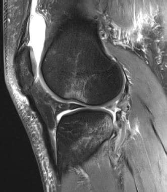 Anterior Cruciate Ligament ACL MRI Practice Essentials Anatomy