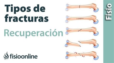 Fracturas De Hueso Cuáles Son Sus Diferentes Tipos Y Su Recuperación