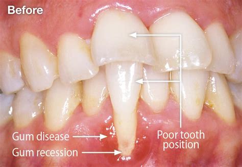 Receding Gums From Dip