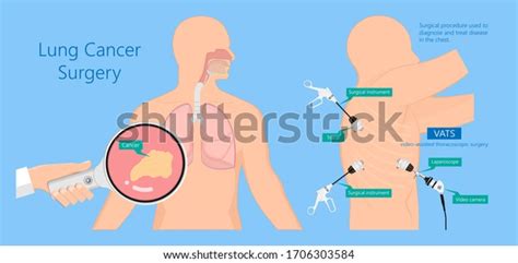 Vats Lung Cancer Treatment Sub Pus Stock Vector Royalty Free 1706303584 Shutterstock