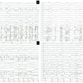 EEG Pattern Changes Of Patient 1 A Convulsive Status Epilepticus