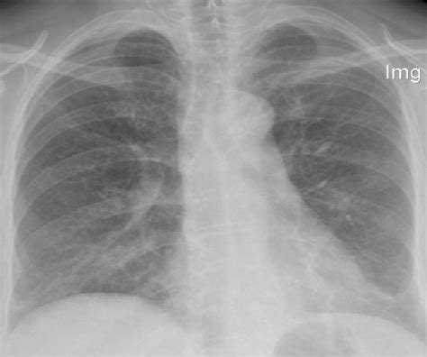 Chest X Ray Shows Patchy Opacifications In Right Mid Zone And Reticular Download Scientific