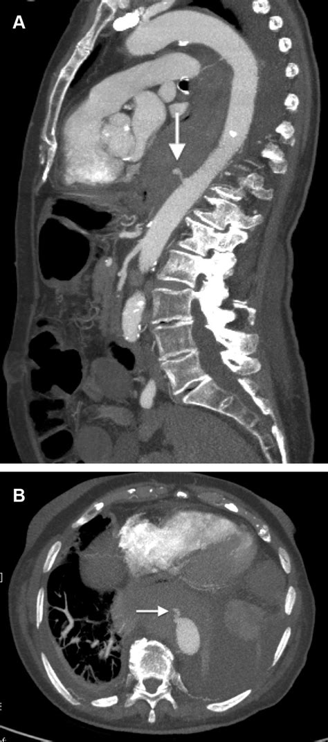 Preoperative Computed Tomography Ct Aortogram Demonstrating The