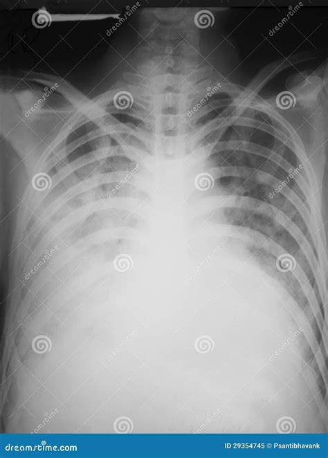 Chest X Ray Film Of A Patient With Pneumothorax Stock Image