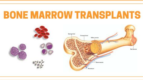 Stem Cell Transplant For Blood Cancers What You Need To Know