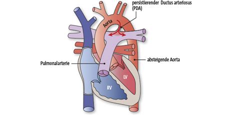 Uke Kinderherzmedizin Emah Pda Persistierender Ductus Arteriosus