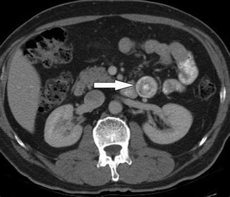 Adult Intestinal Intussusception Ct Appearances And Identification Of