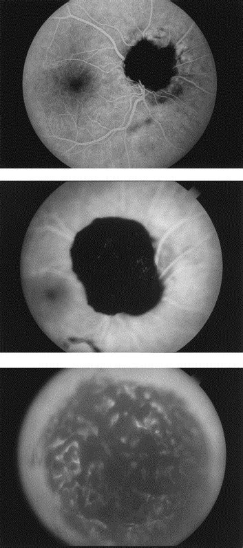 Malignant Transformation Of An Optic Disk Melanocytoma American Journal Of Ophthalmology