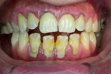 Dental Tartar Before Cleaning Photograph by Dr Armen Taranyan / Science ...