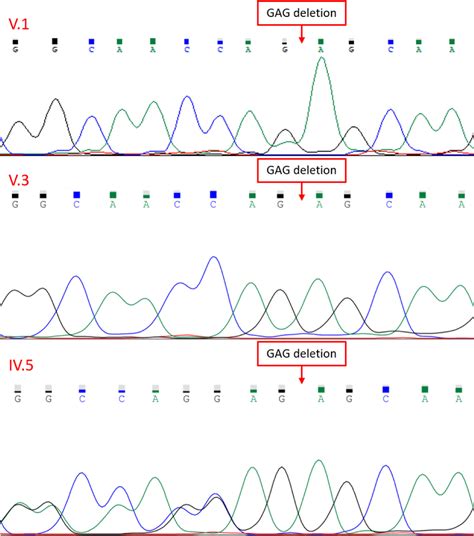 A Rare Cause Of Syncope Naxos Disease Caused By Novel Homozygous