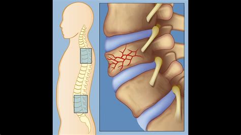 What Is A Lumbar Spine Fracture - Design Talk