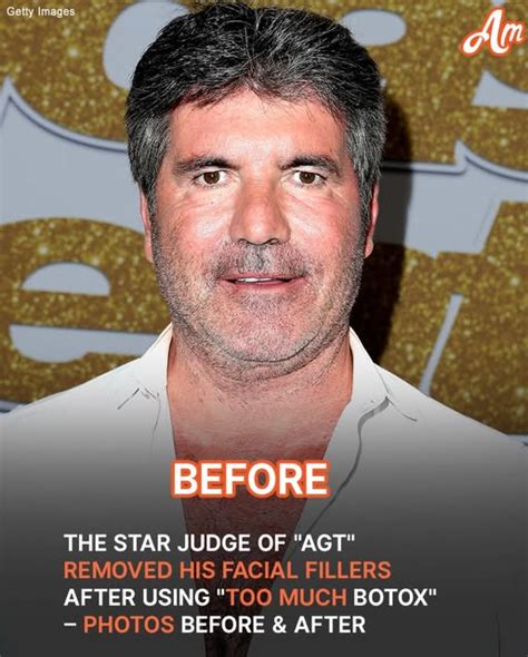 Agt” Judge Simon Cowell Ditched His Facial Fillers After Hardly