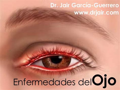 Tipos De Enfermedades De Los Ojos Humanos Consejos Ojos