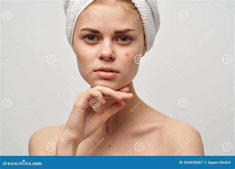 Woman With Towel On Head Naked Shoulders Clear Skin Acne Spa Treatments