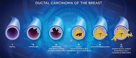 Treating Ductal Carcinoma In Situ Dcis Bidmc Of Boston