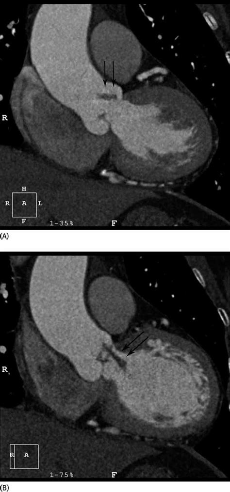 Mobile Aortic Valve Vegetation In A Patient With Infective Endocarditis