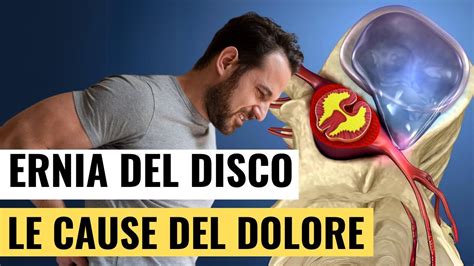 Lombosciatalgia Perchè l Ernia del Disco può causare Dolore alla