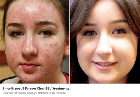 BBL Forever Clear Acne Photofacial Synergy Medical Aesthetics