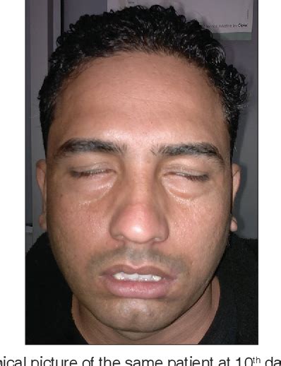 Bilateral Facial Nerve Palsy In A Newly Diagnosed Diabetic Patient With