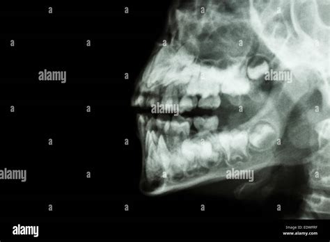 Film X Ray Humans Jaw And Teeth And Blank Area At Left Side Stock