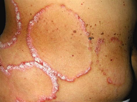 Annular Erythematous Plaques With Scale The BMJ