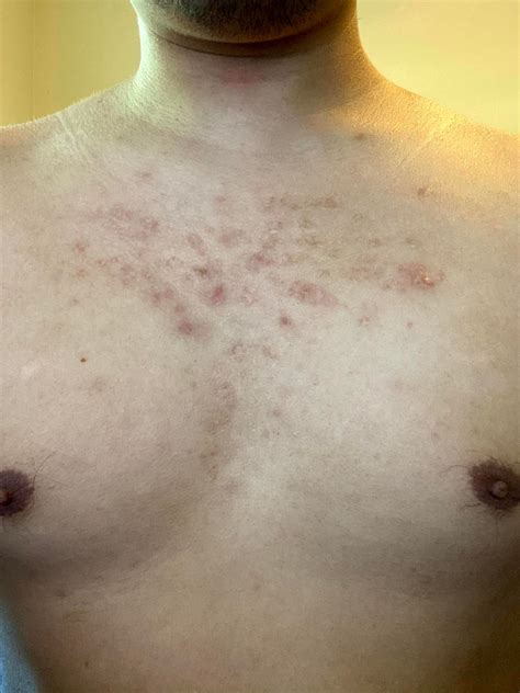 [skin Concerns] Severe Chest Acne Scars That Are Several Years Old Tried Differing Remedies But