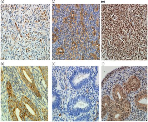 Pdf Ovarian Adult Type Granulosa Cell Tumor Concomitant With Simple