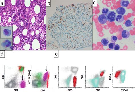 Bone Marrow Biopsy Aspirate And Corresponding Flow Cytometric