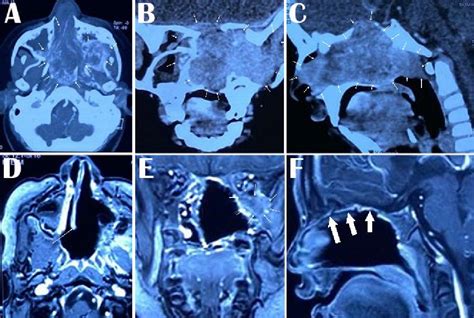 PDF Extended Endonasal Endoscopic EEE Surgery With Almost No Use Of