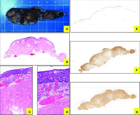 Histopathology For Esd Specimen A Gross Specimen After Esd In Vitro