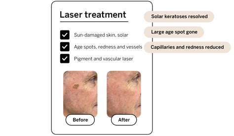 Fractional Laser For Solar Keratoses And Field Cancerisation