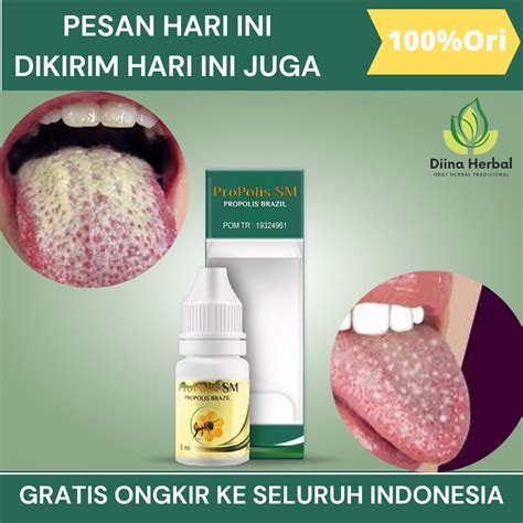 Jual Obat Lidah Putih Berjamur Obat Lidah Pecah Pecah Obat Lidah