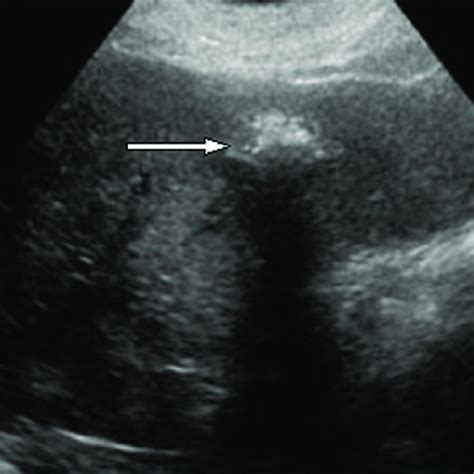 Ultrasound Appearances Of Liver Metastases A Hypoechoic Lesion