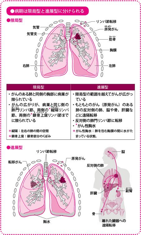 小細胞肺がんの治療、限局型の治療の進め方は？進展型の治療の進め方は？ がんプラス