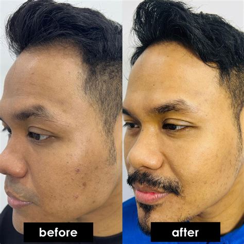 Best Acne Scar Laser Regalion Clinic Kota Damansara