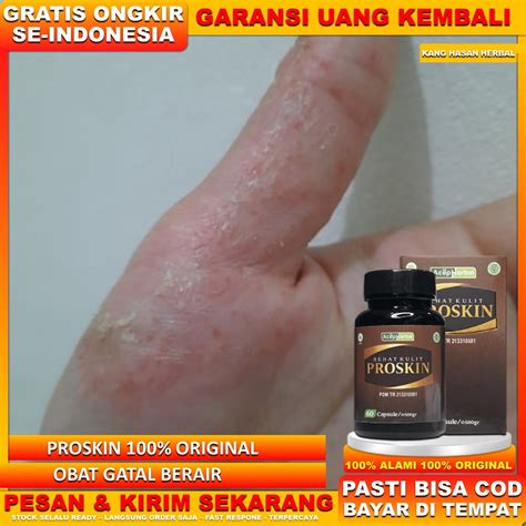 Jual Obat Gatal Berair Obat Gatal Berair Parah Budug Bernanah Obat