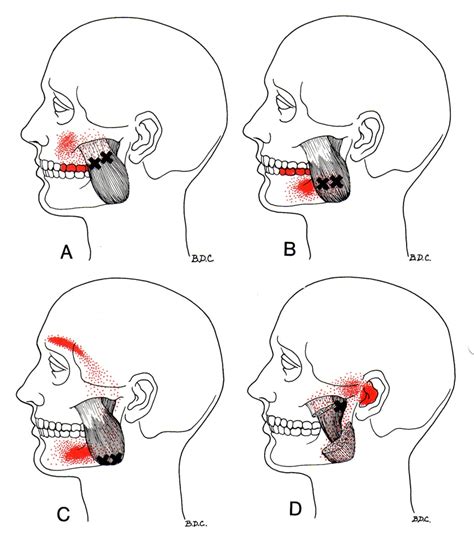 Masseter The Trigger Point And Referred Pain Guide