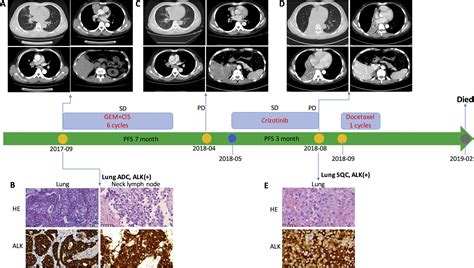 Transformation Of Eml4 Alk Fusion Positive Adenocarcinoma Into Squamous