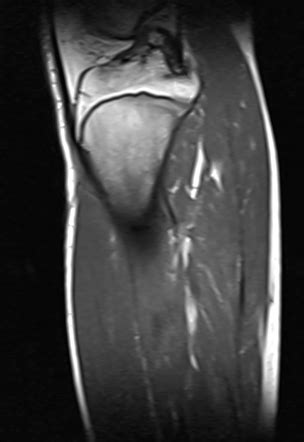 Osteoblastoma Radiology Case Radiopaedia Org