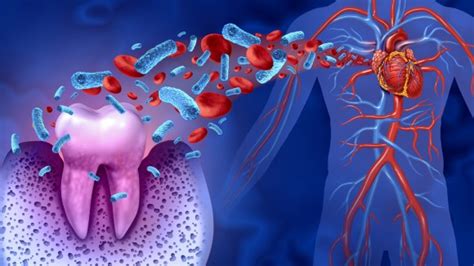 Periodontal Disease And Systemic Health