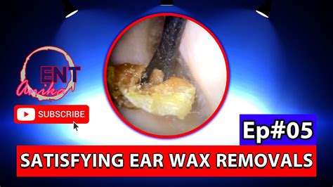 Enormous Ear Wax Removal From Eardrum Ep05 Anikaent