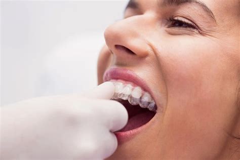 Cómo cuidar los retenedores dentales Clínica Dental Zoco Rivas