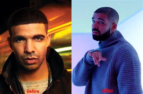 Did Drake Get A Nose Job Plastic Surgery Before After Photos 2018